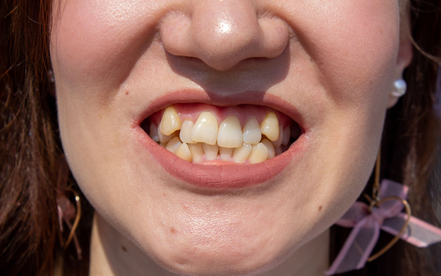 What Causes Crooked Teeth (and Can You Prevent It?)