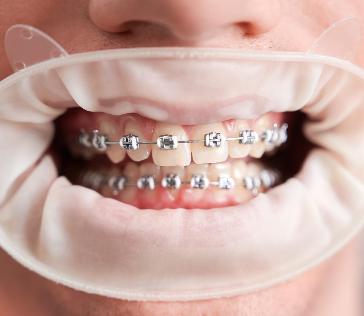 male patient with cofferdam mouth showing teeth with braces