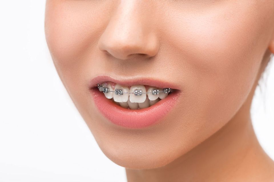A woman smiling, showcasing her braces on her teeth, highlighting her dental treatment and confidence.