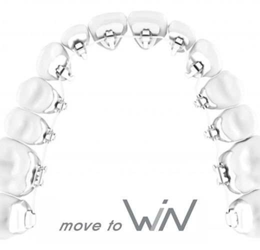 top view of the Win lingual braces 