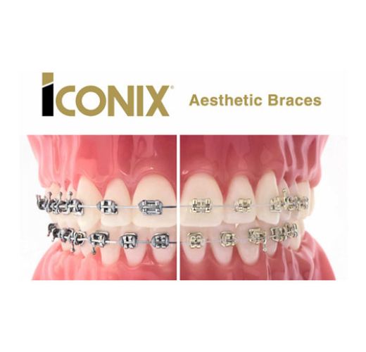 Iconix Braces 