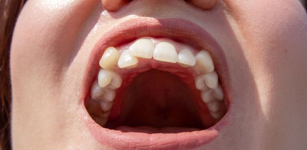 Close shot of an open mouth of a woman with crooked teeth.